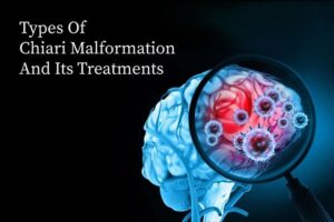 Types-Of-Chiari-Malformation-And-Its-Treatments