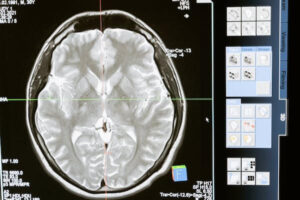 What Causes Chiari Malformation Chiari Decompression Surgery