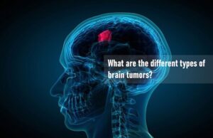 Types Of Brain Tumors