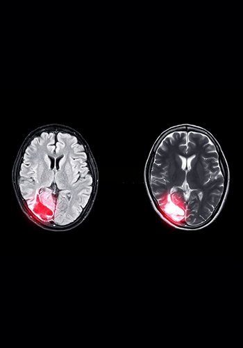 Brain-Spinal-Tumor-Surgery-1