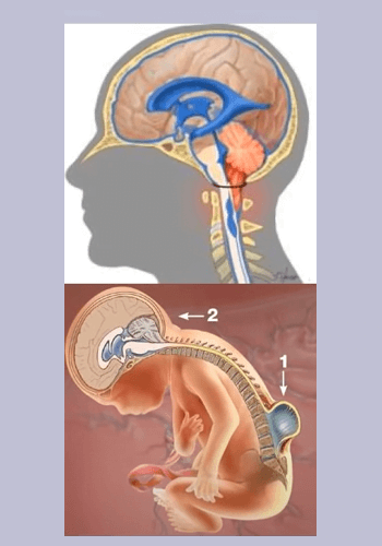 Chiari-Decompression Chiari-Decompression