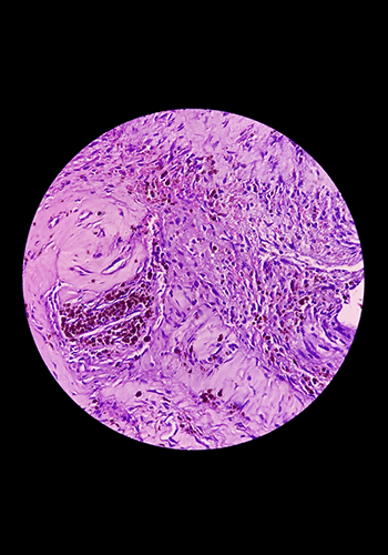 Meningioma-Schwannoma-Neurofibromatosis-Treatment