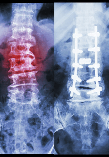Spinal Reconstruction | Dr. Abdul A. Baker, Md - Neurosurgeon