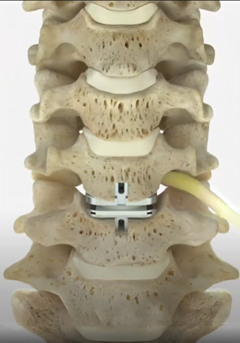 Total Disc Replacement Magnetic Resonance Imaging Spinal Fusion Lumbar Degenerative Disc Disease Spinal Disc Blood Vessels Back Pain Low Back Pain