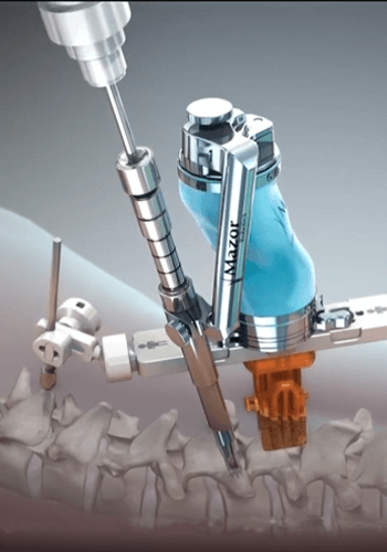 Robotic Spine Surgery | Dr. Abdul A. Baker, Md - Neurosurgeon
