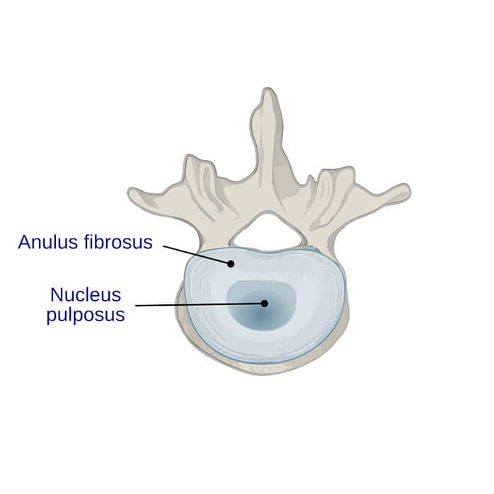 Lumbar Total Disc Replacement Lumbar Disc Replacement Degenerative Disc Disease Artificial Disk Replacement Cervical Disc Replacement