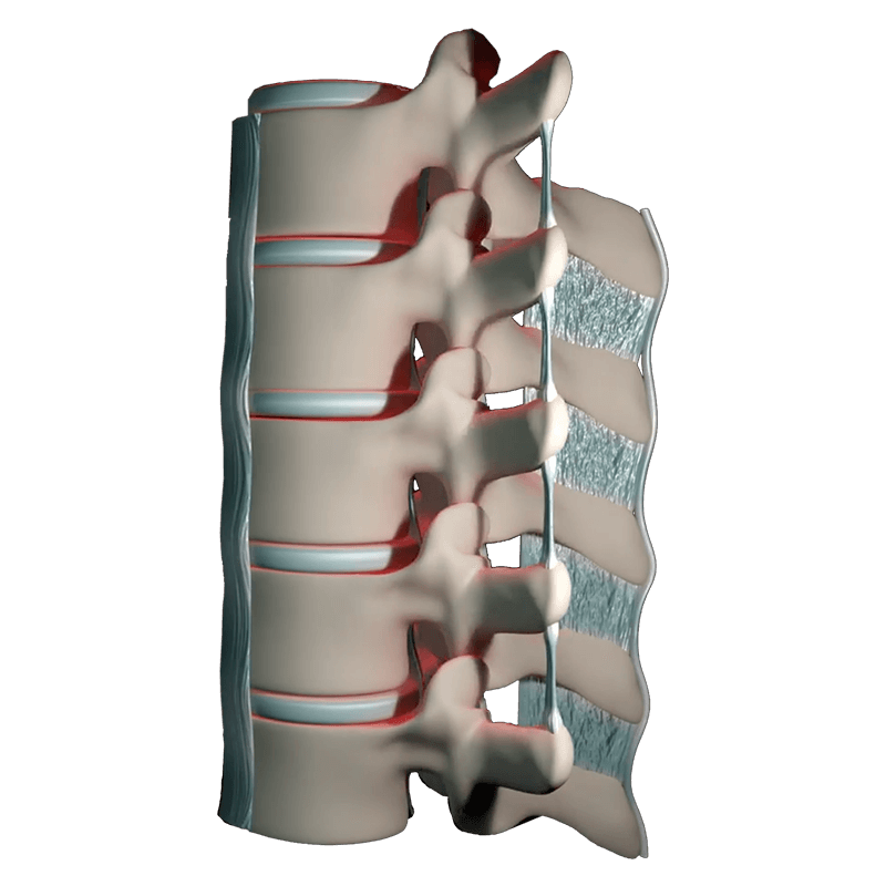 Lumbar Disc Replacement Surgery Degenerative Disc Disease Lumbar Disc Replacement Artificial Disc Cervical Disc Replacement Spinal Fusion Surgery