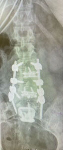 Sagittal Balance: Anterior Lumbar Interbody Fusion Supplemented With Posterior Instrumentation Allows Robust Creation Of Lumbar Lordosis And Improvement Of Sagittal Balance