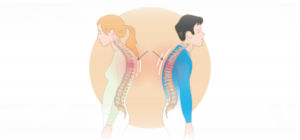 C5 C6 Disc Cervical Herniation Nerve Root Surgical Treatments Spinal Nerve Bulging Disc Ruptured Disc Bowel And Bladder Control Herniated Disc Material Neck Curvature Poor Posture Two Transverse Processes Bladder Control Neck Braces Upper Arms