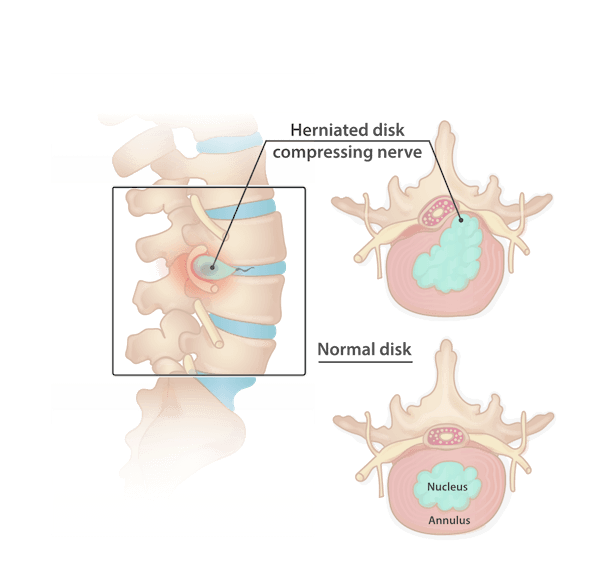 physical examination acupuncture appears bone fusion medical history neurological surgeons pain worse disc protrudes just the protruding portion bowel control shooting pain nerve roots disk herniation spinal nerves physical therapist back pain herniated disks relieve pain