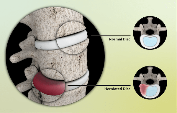 Bulging Disc Treatment Herniated Disc Spinal Cord Physical Therapy Herniated Discs Spinal Canal Neck Pain Leg Pain Herniated Disk Muscle Spasms Spinal Nerve Shock Absorbers Slipped Disc Physical Therapist